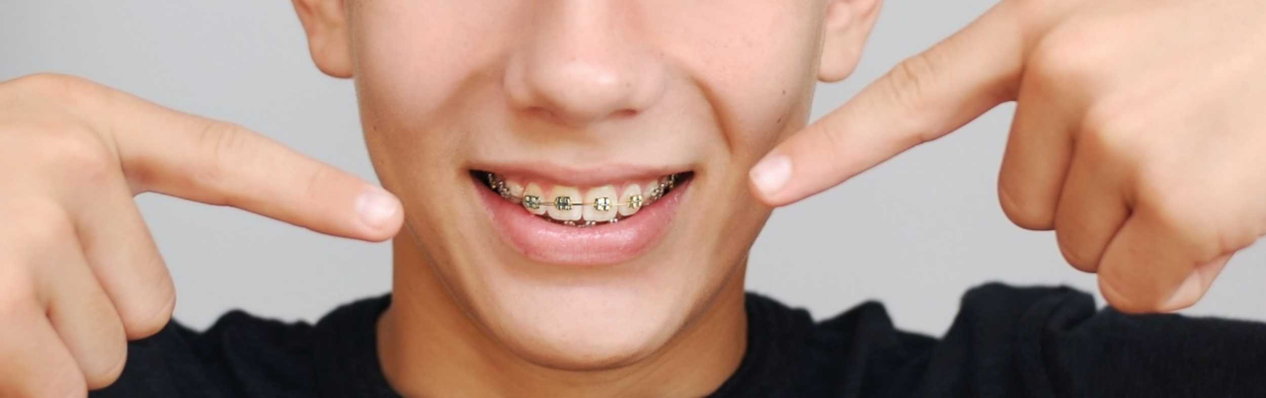 A close up of a smile with braces
